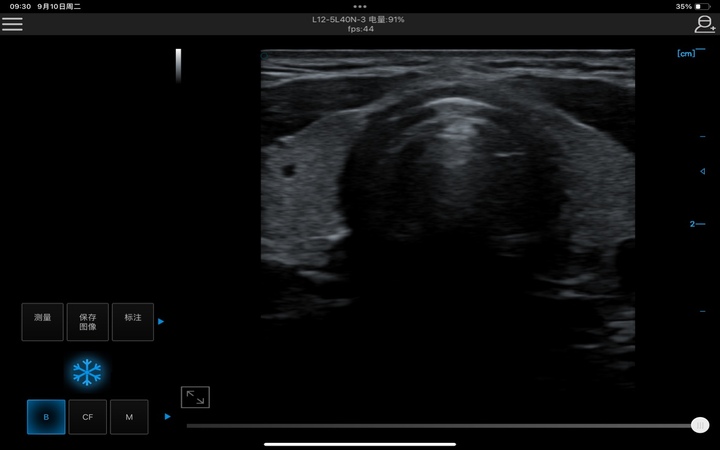 Thyroid 甲状腺
