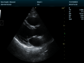心脏B模式 Cardiac B Mode Imaging1
