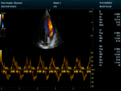 心脏彩色多普勒模式+脉冲多普勒模式Cardiac CF+PW Mode Imaging1