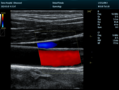 颈动脉血流模式Carotid CF Mode Imaging1