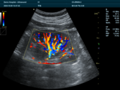 肾脏血流模式Kidney CF Mode Imaging