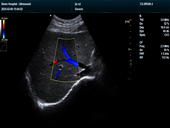 肝脏彩色多普勒模式-Liver-CF Mode Imaging2
