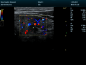 甲状腺血流模式Thyroid CF Mode Imaging1