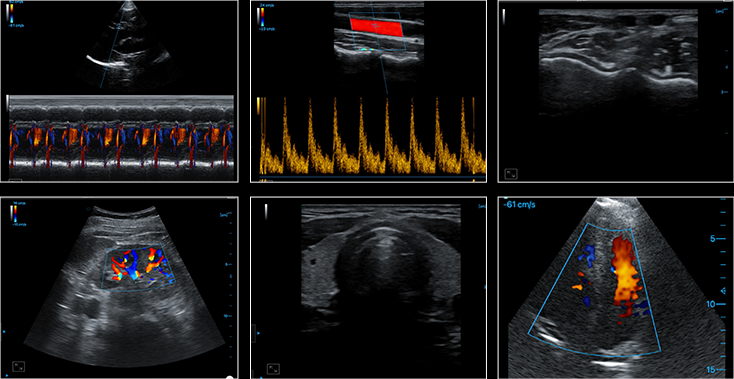 PIU2A ultrasound