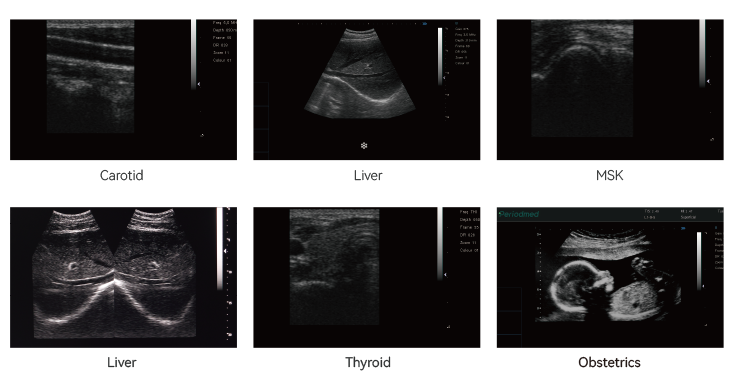 Ultrasound imaging