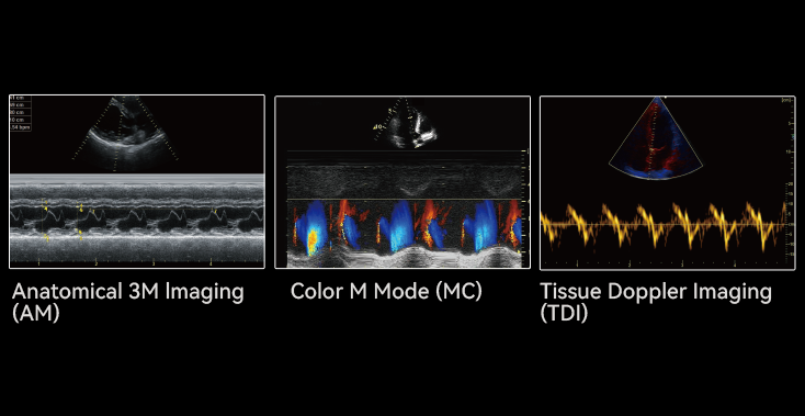 Heart ultrasound imaging