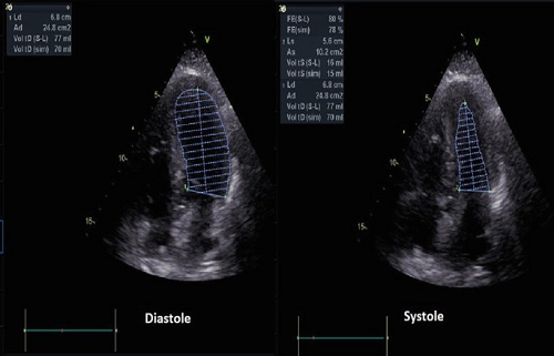 Heart ultrasound