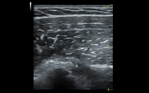 Anterior deltoid 三角肌前束